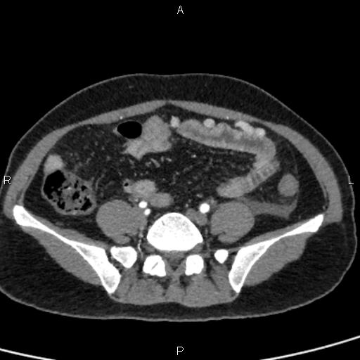 Bilateral adrenal gland hyperenhancement in pancreatitis (Radiopaedia 86642-102753 B 94).jpg