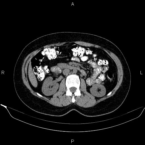 Bilateral adrenal myelolipoma (Radiopaedia 63058-71535 Axial non-contrast 76).jpg