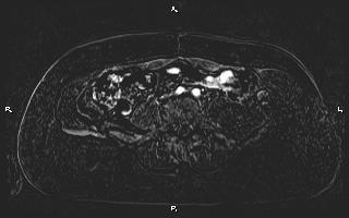 Bilateral adrenal myelolipoma (Radiopaedia 63058-71537 I 76).jpg