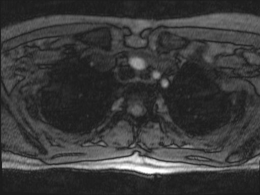 Bilateral carotid body tumors and right glomus jugulare tumor (Radiopaedia 20024-20060 Axial MRA 169).jpg