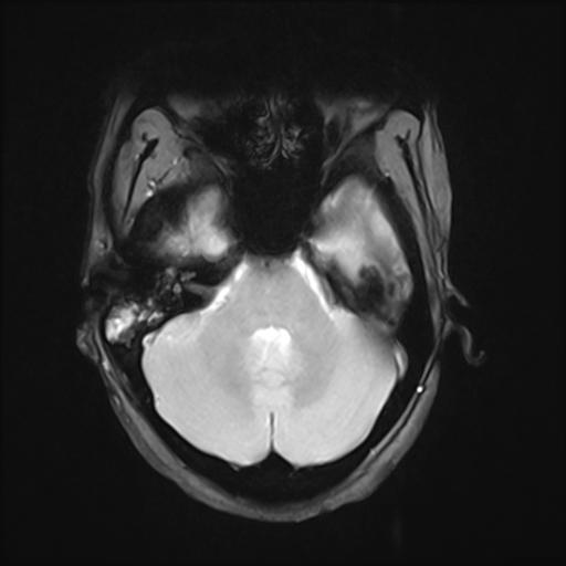 File:Bilateral carotid body tumors and right jugular paraganglioma (Radiopaedia 20024-20060 Axial 81).jpg