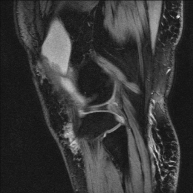 Bilateral focal pigmented villonodular synovitis (Radiopaedia 67643-77073 Sagittal T1 vibe 13).jpg