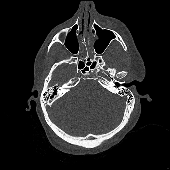 File:Bilateral occipital condyle fracture (type 2) (Radiopaedia 87675-104089 Axial bone thins 64).jpg