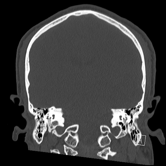 Bilateral occipital condyle fracture (type 2) (Radiopaedia 87675-104089 Coronal bone window 81).jpg