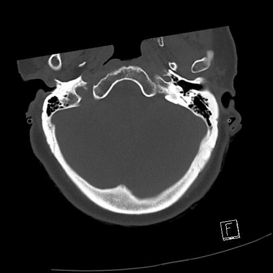 Bilateral occipital condyle fractures (type 3) (Radiopaedia 87672-104086 Axial bone window 3).jpg