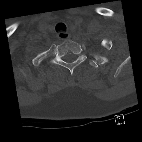 Bilateral occipital condyle fractures (type 3) (Radiopaedia 87672-104086 Axial bone window 72).jpg