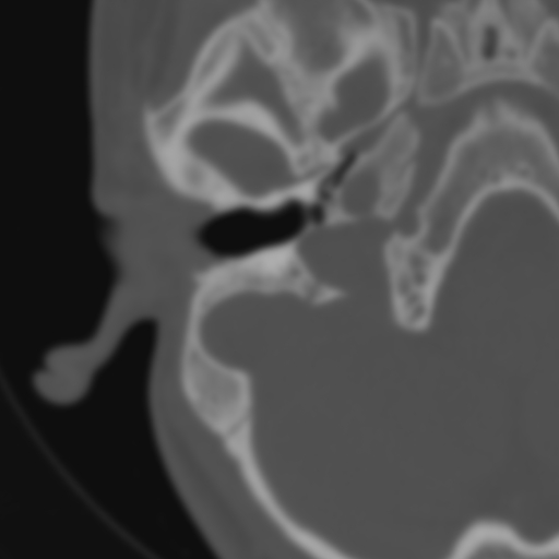 Bilateral otosclerosis (Radiopaedia 57237-64157 B 38).jpg