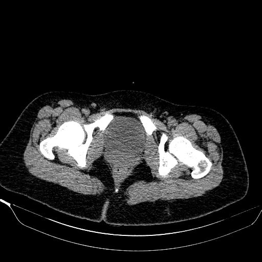 File:Bilateral ovarian dermoid (Radiopaedia 45714-49907 Axial non-contrast 44).JPEG