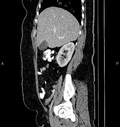 Bilateral ovarian dermoid cysts (Radiopaedia 85785-101603 D 22).jpg