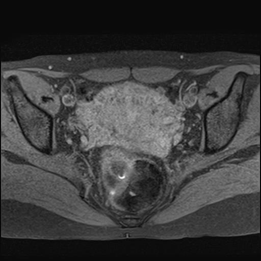 File:Bilateral ovarian endometriomas (Radiopaedia 87085-103347 Axial T1 fat sat 12).jpg