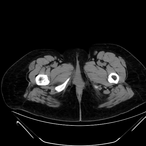 File:Bilateral ovarian mature cystic teratomas (Radiopaedia 79373-92457 Axial non-contrast 107).jpg