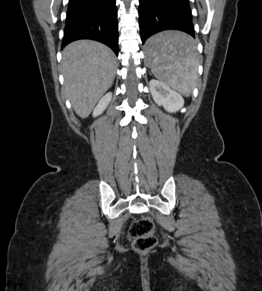 Bilateral ovarian mature cystic teratomas (Radiopaedia 79373-92457 B 84).jpg