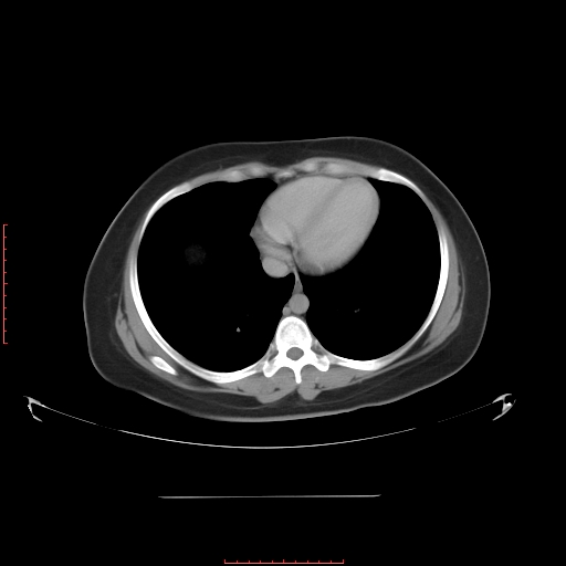 File:Bilateral ovarian serous cystadenocarcinoma with right ovarian torsion (Radiopaedia 32640-33611 A 3).jpg