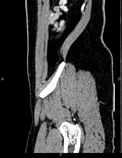 Bilateral ovarian teratoma (Radiopaedia 83131-97503 D 99).jpg