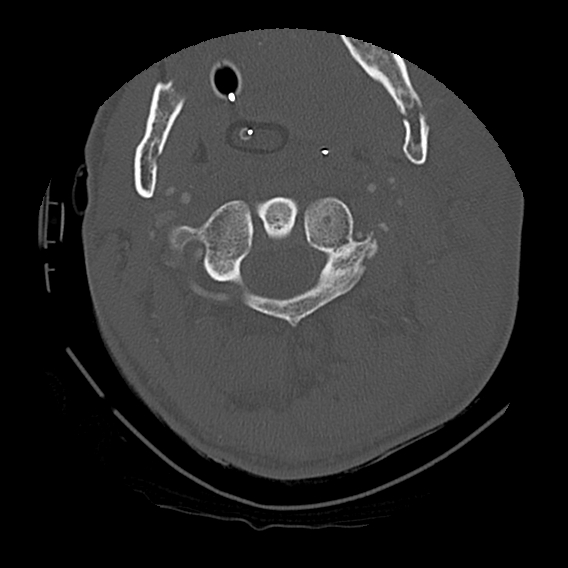 File:Bilateral perched facets with cord injury (Radiopaedia 45587-49713 Axial bone window 29).jpg