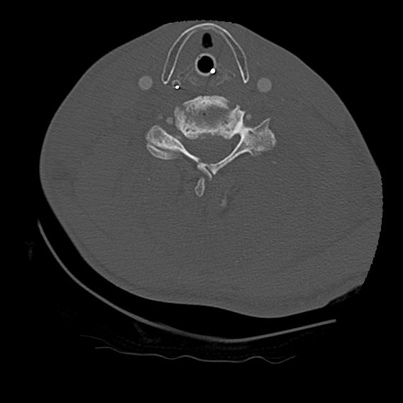 File:Bilateral perched facets with cord injury (Radiopaedia 45587-49713 Axial bone window 71).jpg