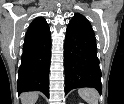Bilateral pulmonary AVM (Radiopaedia 83134-97505 C 58).jpg