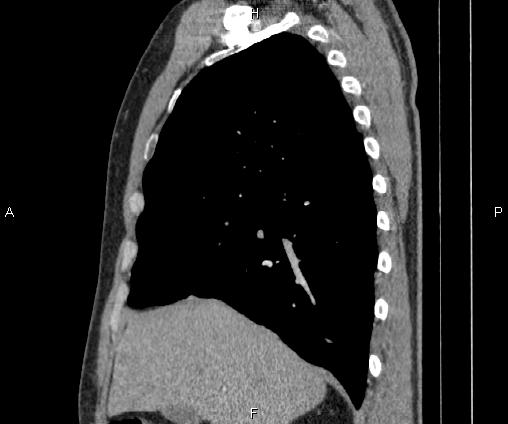 Bilateral pulmonary AVM (Radiopaedia 83134-97505 D 41).jpg
