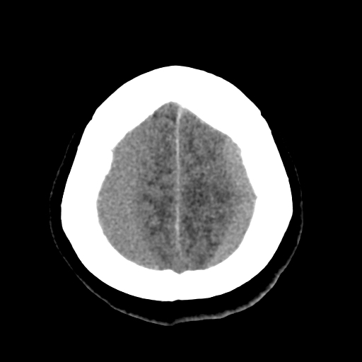 File:Bilateral subacute subdural hematoma (Radiopaedia 69240-79018 Axial non-contrast 44).jpg