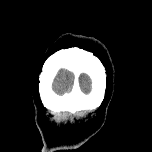 Bilateral subacute subdural hematoma (Radiopaedia 69240-79018 Coronal non-contrast 56).jpg