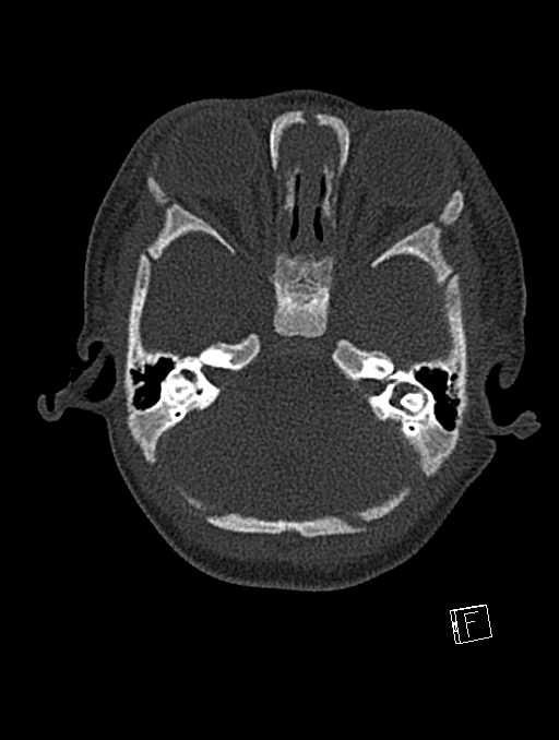 Bilateral subdural hemorrhage and parietal skull fracture (Radiopaedia 26058-26192 Axial bone window 105).png