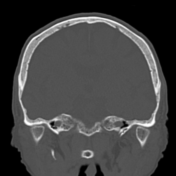 Biparietal osteodystrophy (Radiopaedia 46109-50463 Coronal bone window 56).jpg