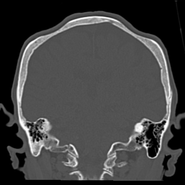 Biparietal osteodystrophy (Radiopaedia 46109-50463 Coronal bone window 67).jpg