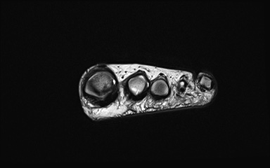 Bipartite hallux sesamoid diastasis (Radiopaedia 77133-89109 Coronal PD 33).jpg