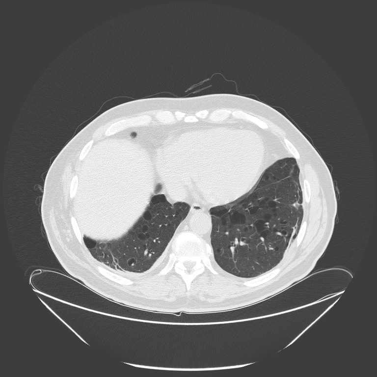 Birt-Hogg-Dubé syndrome (Radiopaedia 52578-58491 Axial lung window 46).jpg