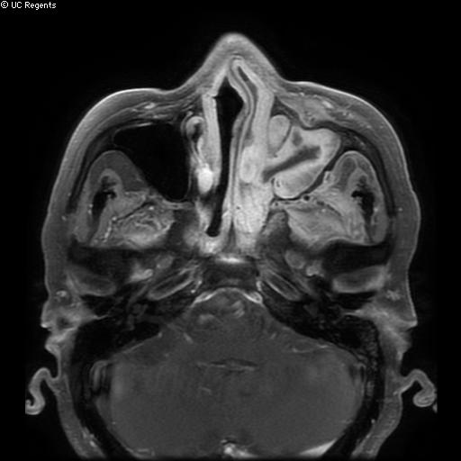 File:Bisphosphonate-related osteonecrosis of the maxilla (Radiopaedia 51367-57101 Axial T1 C+ fat sat 28).jpg