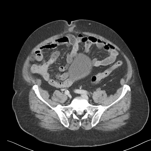 File:Bladder papillary urothelial carcinoma (Radiopaedia 48119-52951 Axial 41).png