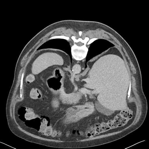 File:Bladder papillary urothelial carcinoma (Radiopaedia 48119-52951 Axial C+ delayed 6).png