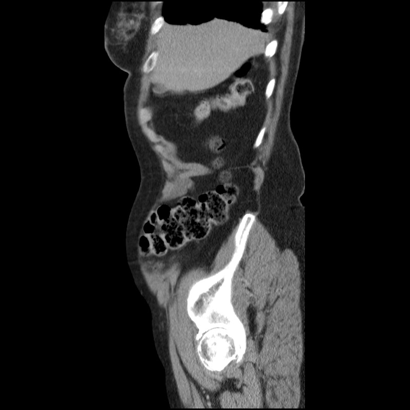 Bladder tumor detected on trauma CT (Radiopaedia 51809-57609 E 62).jpg