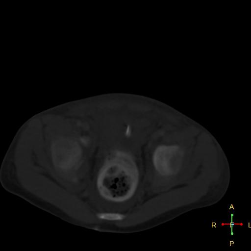 File:Blunt abdominal trauma (Radiopaedia 24780-25044 Axial bone window 15).jpg