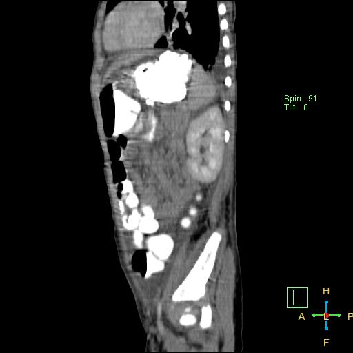 File:Blunt abdominal trauma (Radiopaedia 24780-25044 D 10).jpg