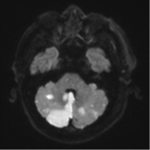 File:Blunt cerebrovascular injury (Radiopaedia 53682-59745 Axial DWI 39).png