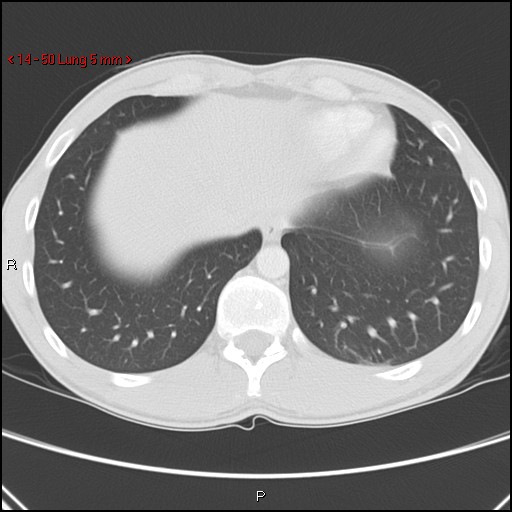 Blunt chest trauma - pulmonary interstitial emphysema and pneumomediastinum (Radiopaedia 20666-20552 Axial lung window 50).jpg