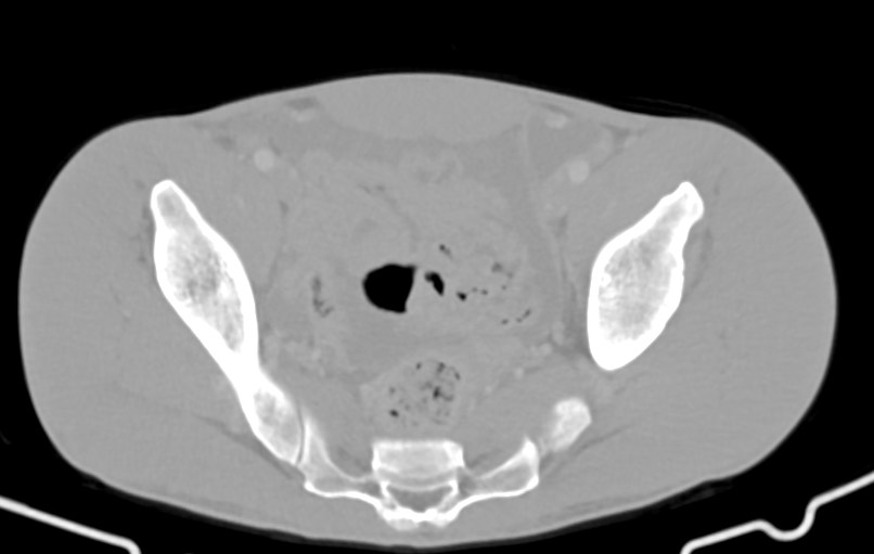 Blunt injury to the small bowel (Radiopaedia 74953-85987 Axial Wide 83).jpg