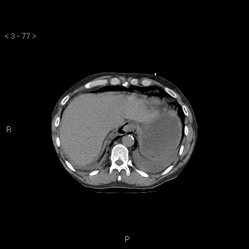 File:Boerhaave syndrome (Radiopaedia 27683-27897 Axial non-contrast 77).jpg