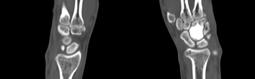 Bone islands - carpus (Radiopaedia 63141-71658 Coronal bone window 30).jpg