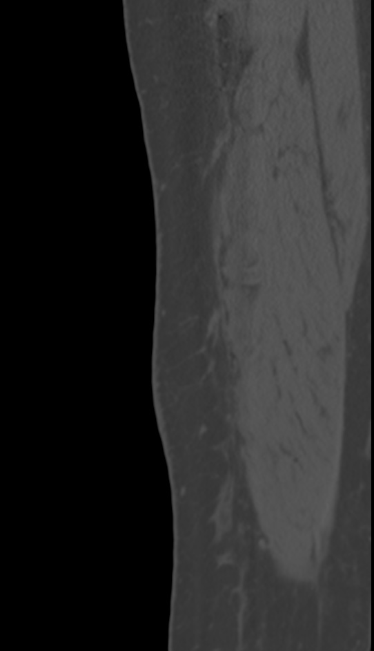 Bone metastasis - tibia (Radiopaedia 57665-64609 Sagittal bone window 18).jpg