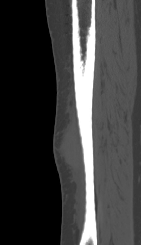 Bone metastasis - tibia (Radiopaedia 57665-64609 Sagittal bone window 46).jpg