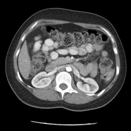 File:Borderline mucinous tumor (ovary) (Radiopaedia 78228-90808 A 55).jpg