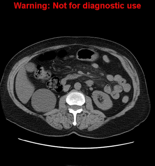 File:Bosniak renal cyst - type II (Radiopaedia 23404-23468 Axial non-contrast 17).jpg