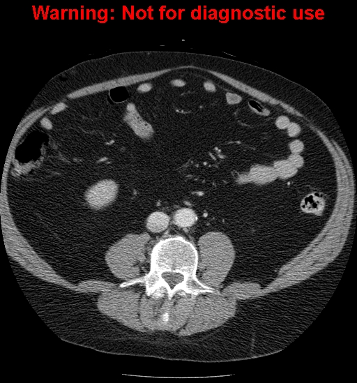 File:Bosniak renal cyst - type IV (Radiopaedia 23402-23466 D 43).jpg