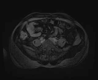 Bouveret syndrome (Radiopaedia 61017-68856 Axial T1 C+ fat sat 72).jpg