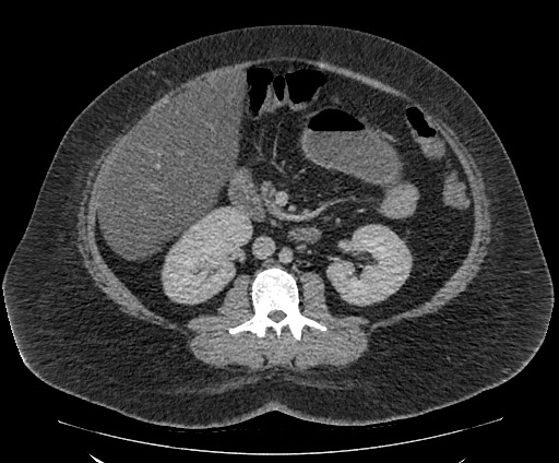 Bowel and splenic infarcts in acute lymphocytic leukemia (Radiopaedia 61055-68913 A 62).jpg