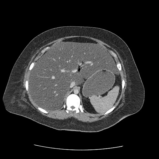 Bowel and splenic infarcts in acute lymphocytic leukemia (Radiopaedia 61055-68915 A 39).jpg