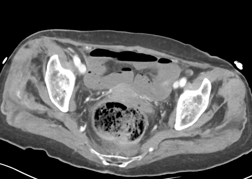 File:Bowel ischemia (Radiopaedia 58273-65382 A 57).png