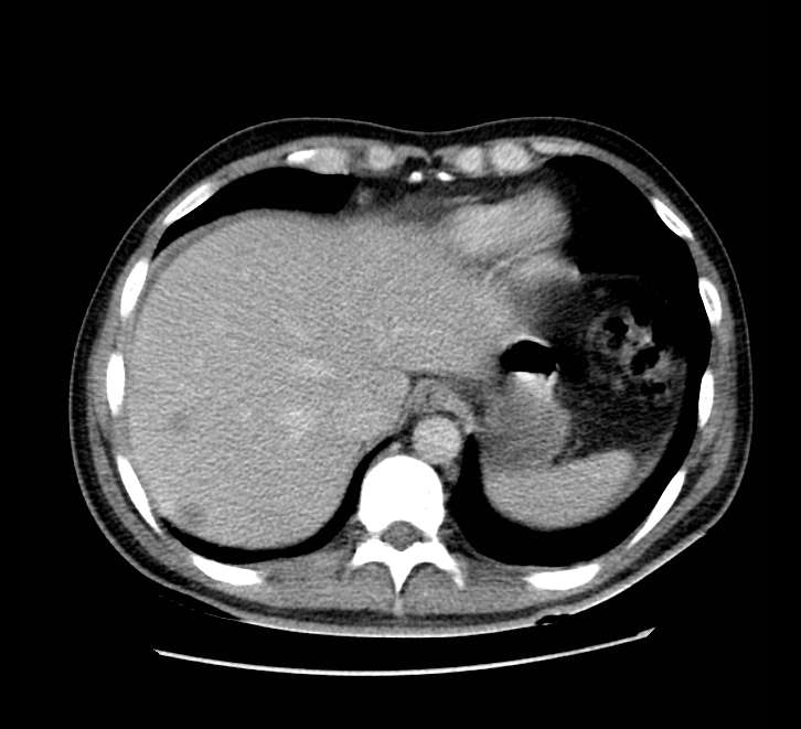 Bowel obstruction from colon carcinoma (Radiopaedia 22995-23028 A 12).jpg